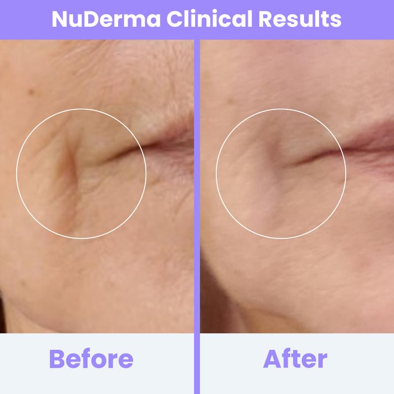 NuDerma Clinical High Frequency Wand with Fusion Neon-Argon Applicators Anti-Aging Anti-Acne by Pure Daily Care