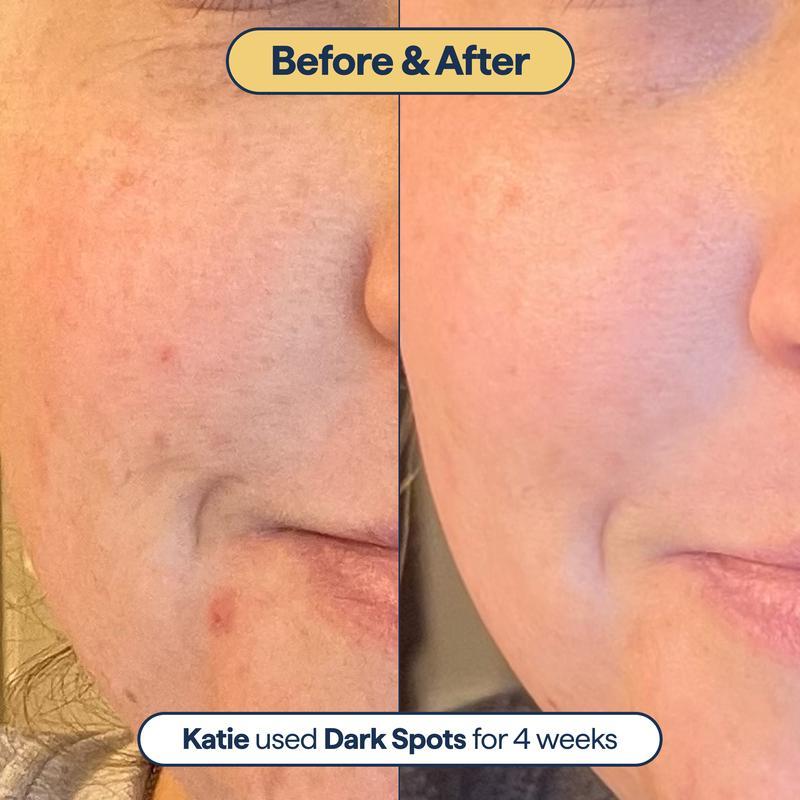 REMEDY for dark spots | All-in-one dark spot correcting treatment