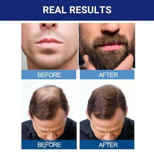 Kirkland Minoxidil 5% Hair Regrowth Solution Extra Strength Men 1 Month Supply Hair Care Comfort