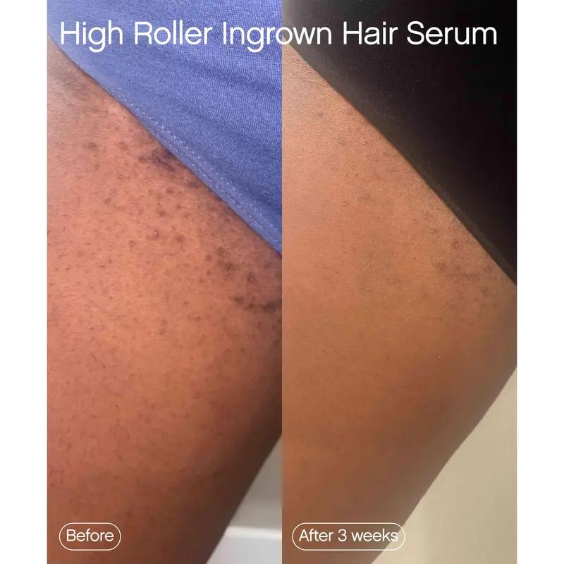 Armpit cleaning Serum for Eliminating Ingrown Hairs and Razor Bumps - Skincare Aftershave Foam