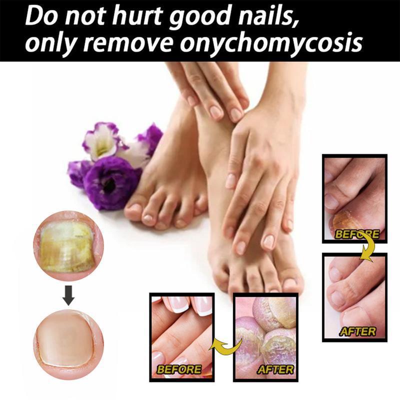 [Free Shipping]Nail Care Moisturizer+ Healmuse Fungal Prevention Solution.Nail Health Care Solution with Tea Tree Oil, Nail Care. Nail Art. Comfort. nail support